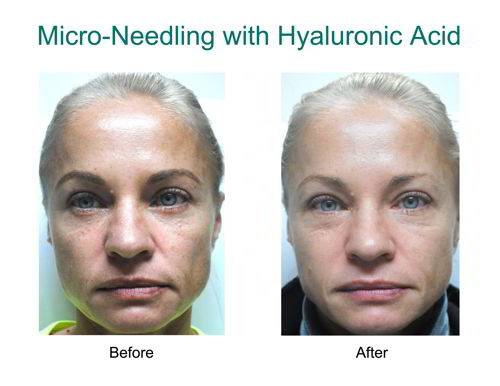 hyaluronic before and after