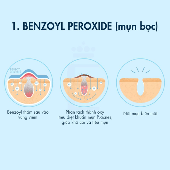 benzoyl peroxide trị mụn