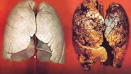 Talc và ung thư phổi