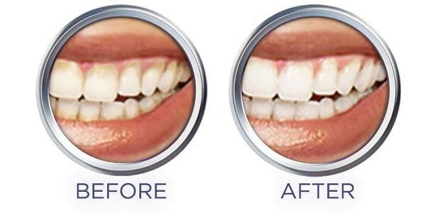 Kết quả trắng răng của kem đánh răng Crest 3D White.